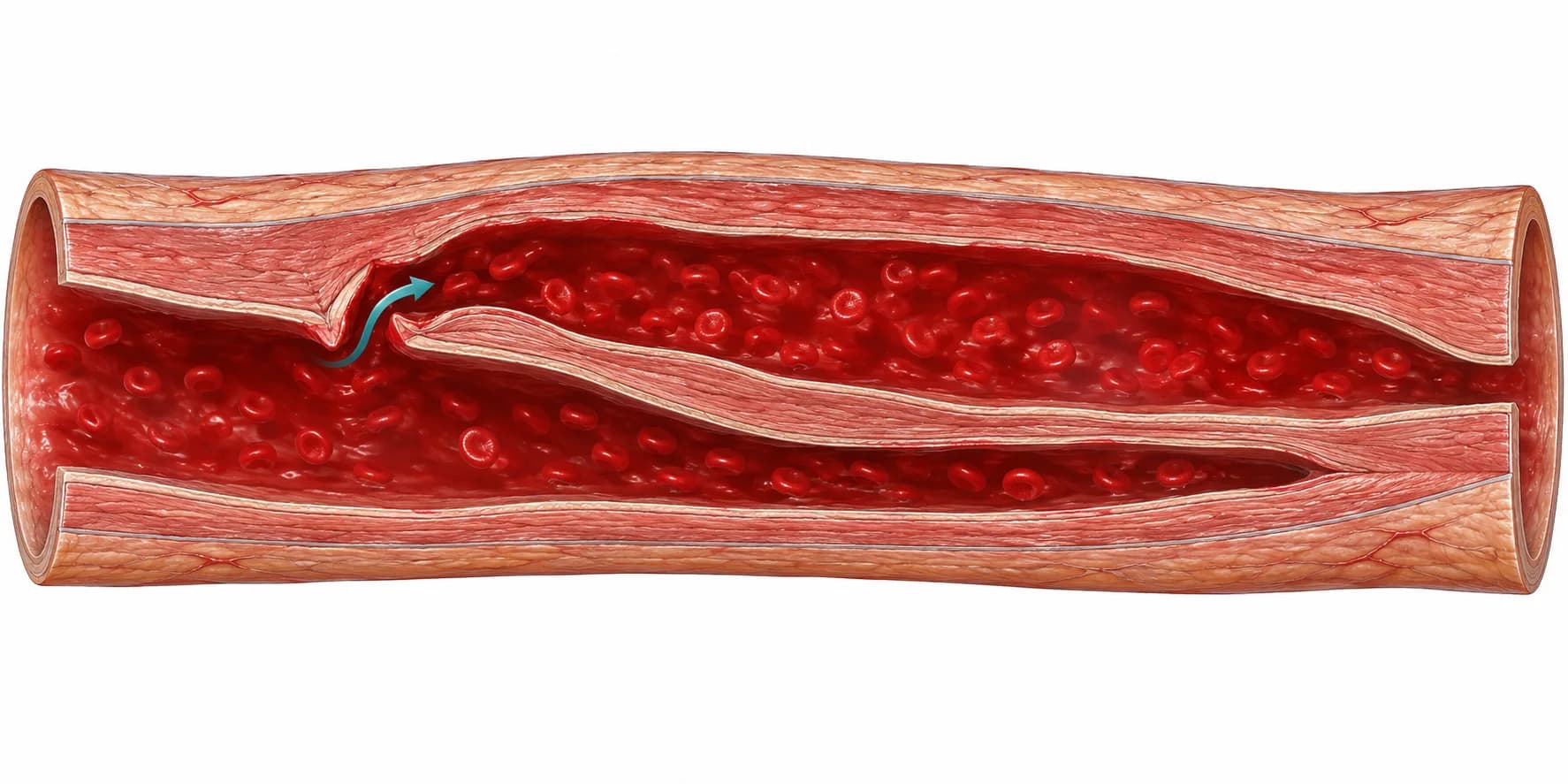 Cut-away illustration from NurseNest cardiovascular lessons of an aorta with a tear in its inner lining, where blood has split the wall into a false channel running alongside the narrowed true channel.